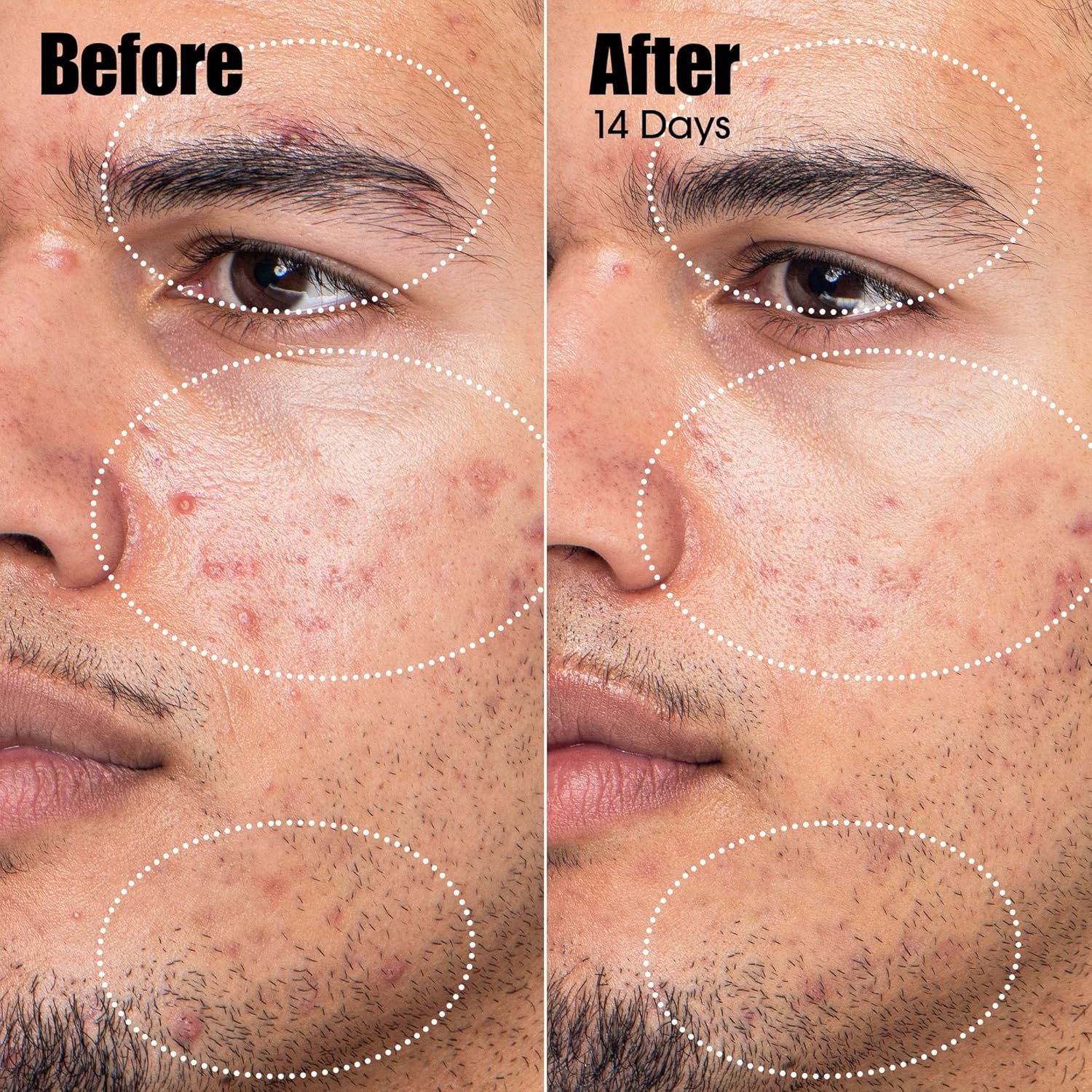 Sunday Riley Peacekeeper Azaleic and Salicylic Acid Acne Treatment Serum(Off White) - view 3