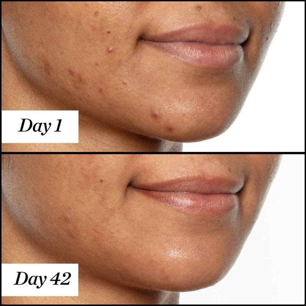 Sunday Riley U.F.O. Ultra-Clarifying Salicylic Acid and Tea Tree Acne Treatment Face Oil(0.5 Fl Oz (Pack of 1)) - view 6